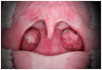 Tonsils