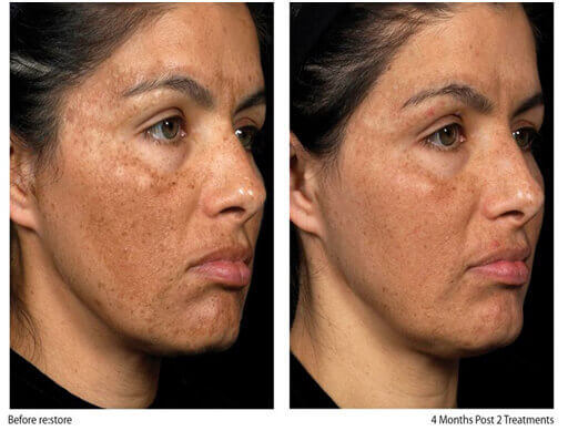 Melasma