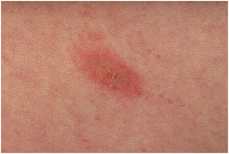 Pityriasis